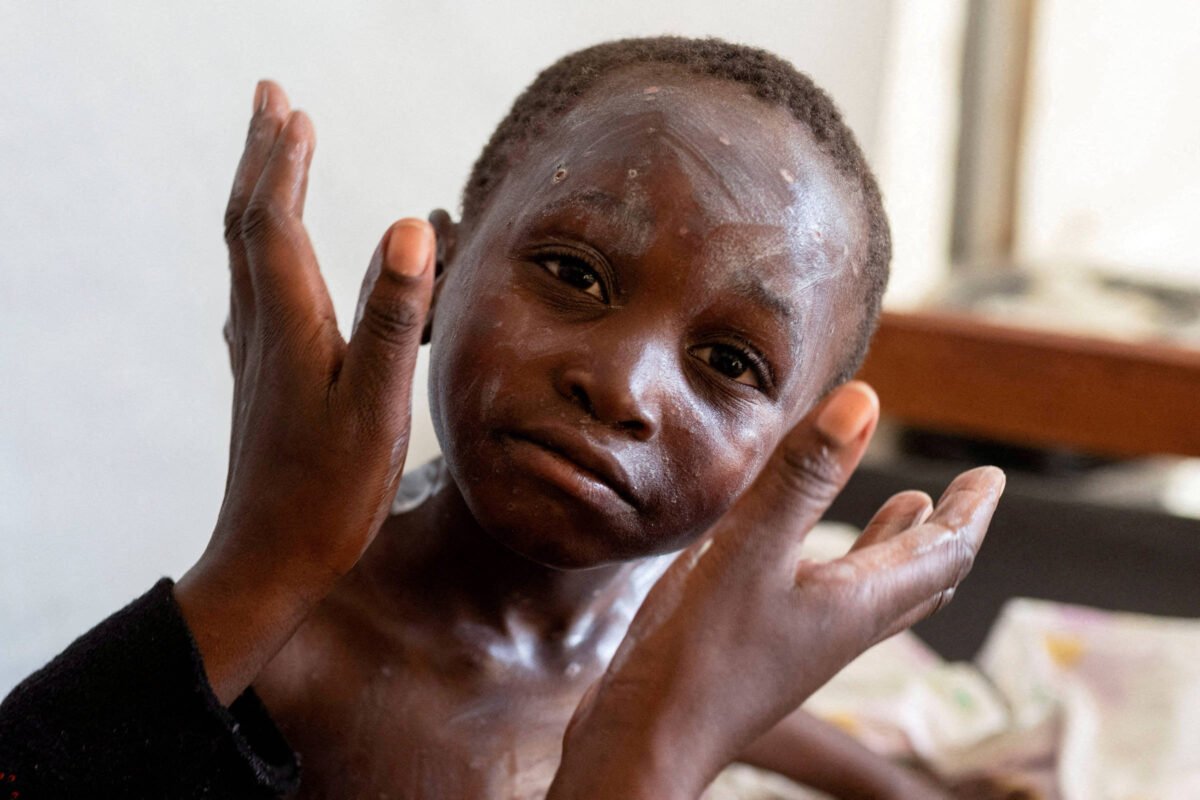 Mpox: combater estigma é chave para encerrar surto Burundi -